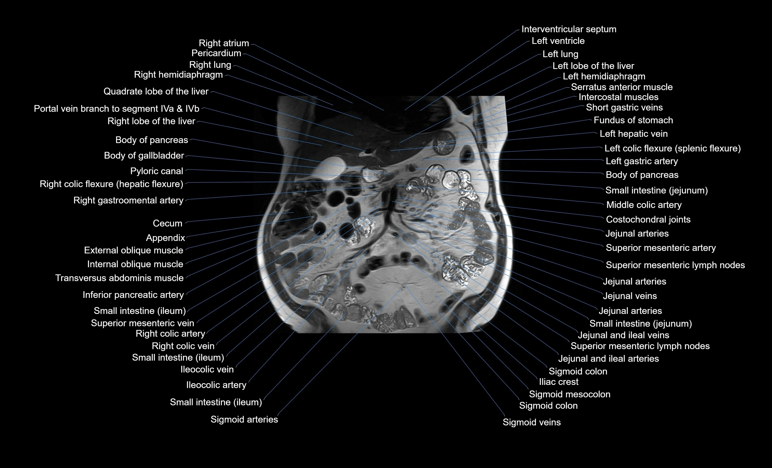 MRI Abdomen coronal labelled cross sectional anatomy radiology  image-img-00001-00023.webp